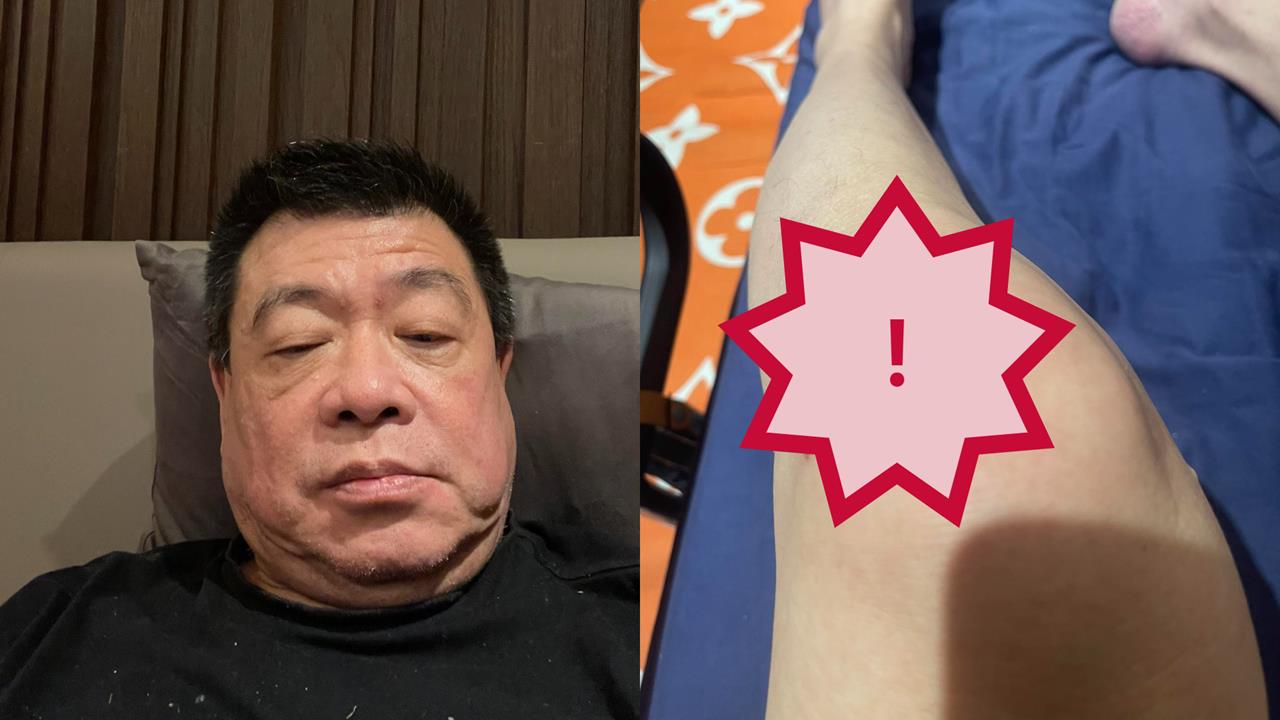 聲援于朦朧收死亡威脅 孫德榮突曬傷勢照曝「4天摔3次」:再跌恐上西天!