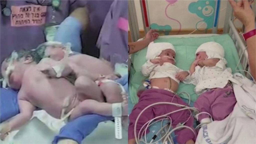 終於獨立了！以色列連體嬰後腦相連1年　花12小時手術「姊妹能對看了」