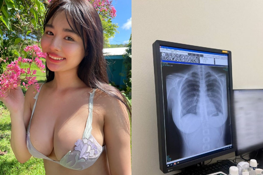 寫真偶像炫耀「肺很乾淨」曬X光照！超扯畫面3千萬網友全歪樓：重點不在肺