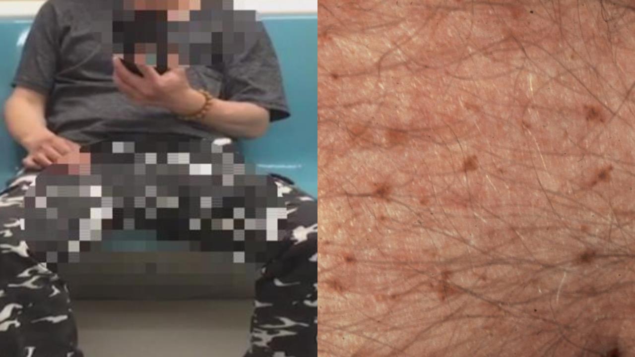 阿北下面奇癢「找妹妹被勸看醫生」！褲子一脫⋯醫看呆：都是銀白色雪花蟲卵