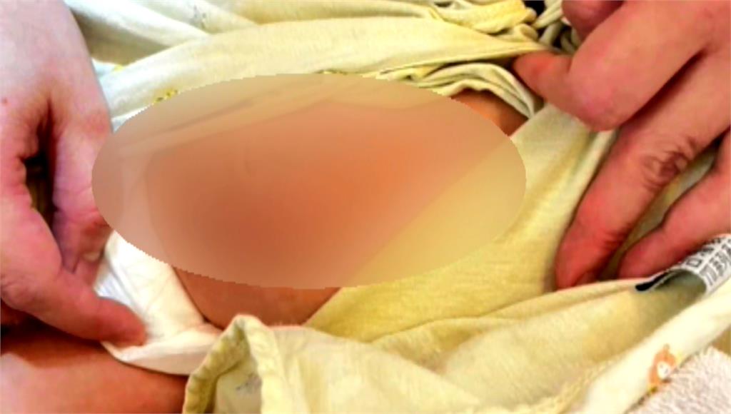 嘉義1個月大男嬰疑受虐　腹部出現大片瘀、抓痕