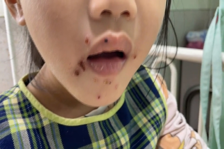 4歲女童滿嘴紅疹、水泡　不是腸病毒是「這個病」