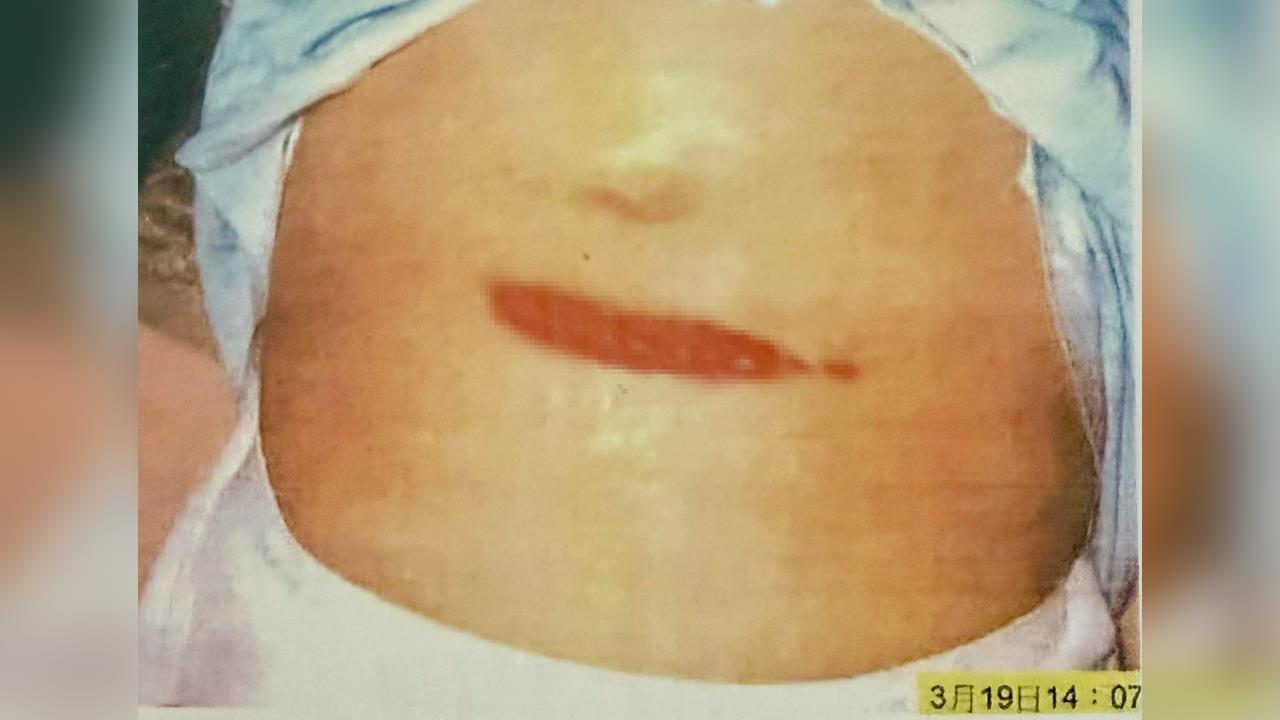 快新聞／319槍擊案22週年！陳水扁公布傷口照　嘆「沒有新發現就應結案」