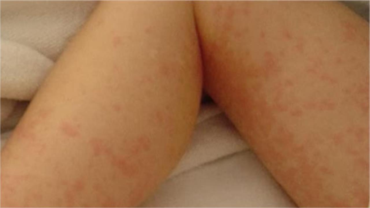 16歲女「手腳脫屑」醫一看驚竟是梅毒！初期1症狀恐誤判「這族群」暴增最明顯