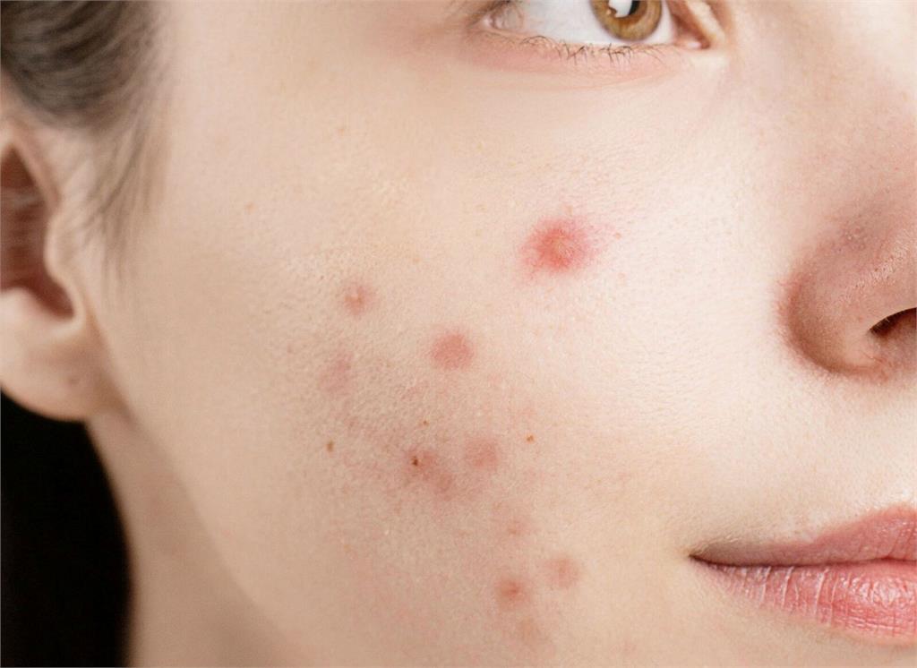 成年人大爆「青春痘」要小心   她治療痘痘驚見肝功能異常!