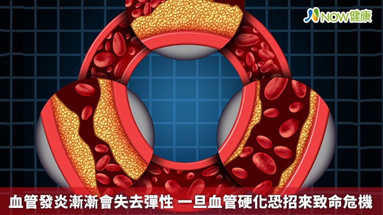 血管發炎漸漸會失去彈性 一旦血管硬化恐招來致命危機