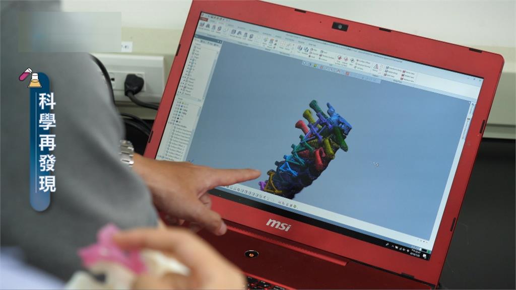 結合3D列印技術　為脊椎側彎病患注入新希望