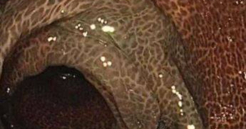 喝通便茶10年！陸女連5天拉不出送醫　慘變「豹紋腸」切30cm保命