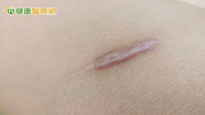 業務員全身多處蟹足腫影響自信　「這些方式」積極治療擺脫惱人症狀