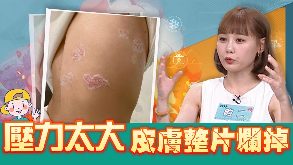 畇二熬夜到天亮竟染「皮蛇」!醫揭「這事」太少恐釀壓力荷爾蒙飆升！