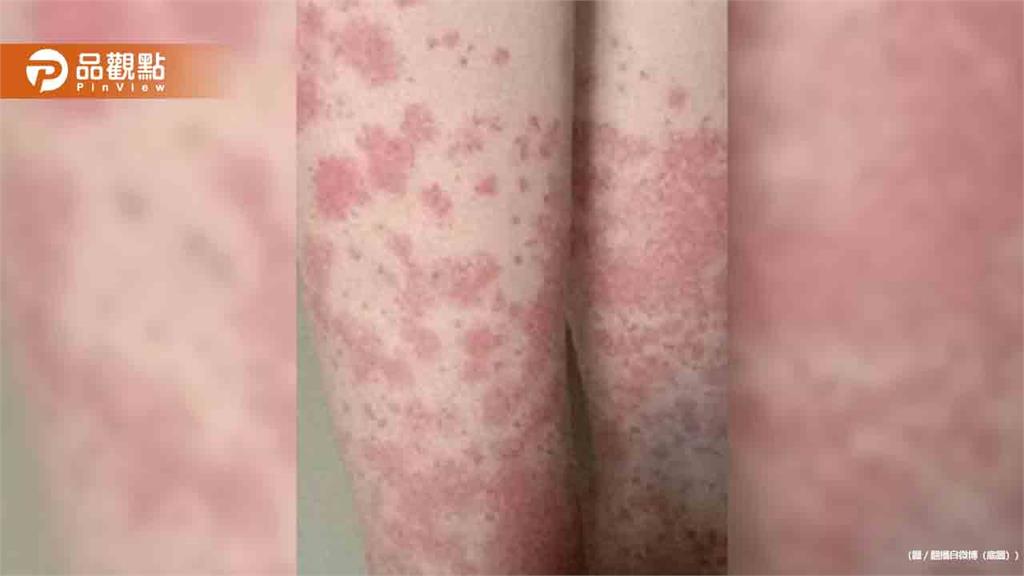 20歲女大生狂染髮「全身爆紫斑」險喪命