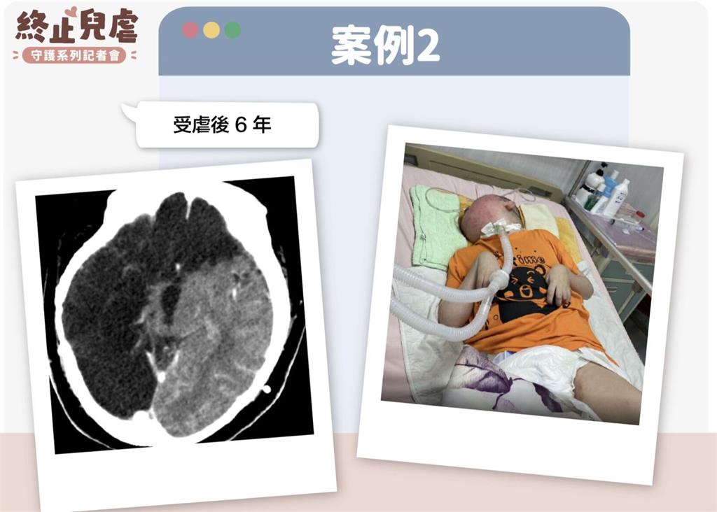 台灣每年26件重大兒虐 一半全是「受虐性腦傷」要命或致殘