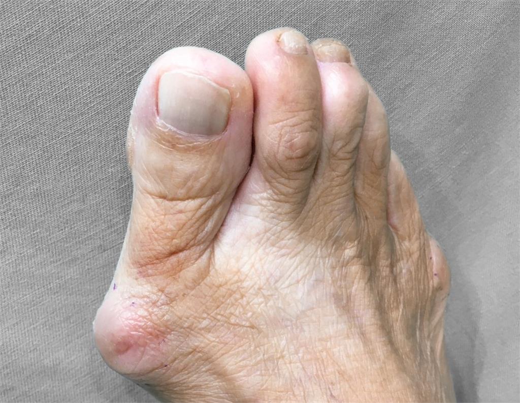 拇指外翻怎根治？關鍵在於嚴重程度！醫師一次解析：常見「5症狀」、「2種」治療方式！