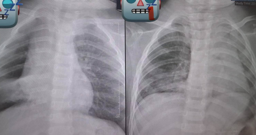 1歲童被餵整顆花生「肺部塌陷」！　醫氣炸曝：死死塞住支氣管