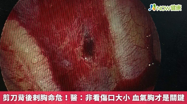 剪刀背後刺胸命危！醫：非看傷口大小 血氣胸才是關鍵