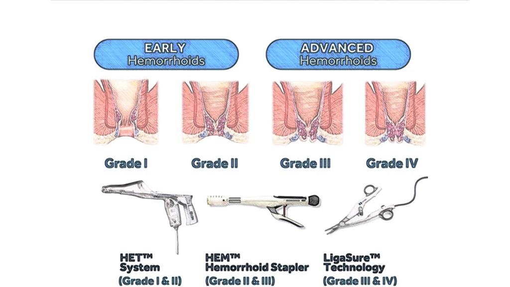 名醫妙方／痔瘡手術免驚！多元微創「客製化」！門診進行當天回家！