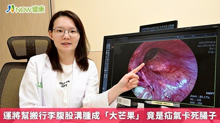 運將幫搬行李腹股溝腫成「大芒果」 竟是疝氣卡死腸子