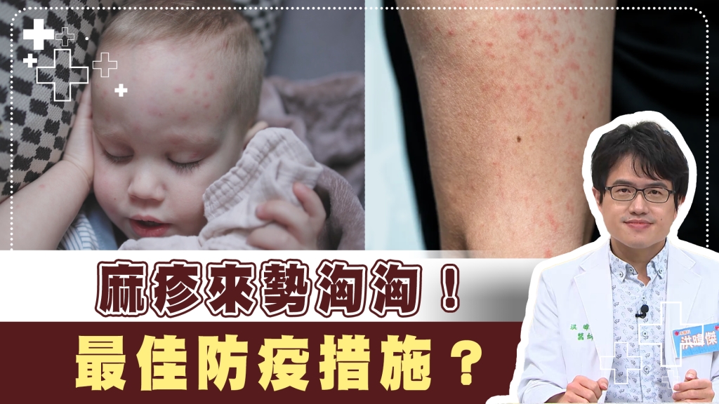 麻疹未發病前4天就有傳染性! 避免重症「這方法」達90%保護力!