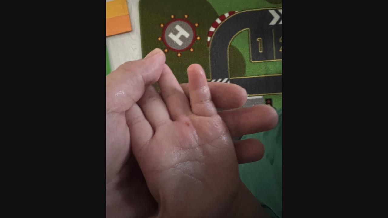 台東兒童運動公園"彈跳床傷人" 小朋友手被刺破手