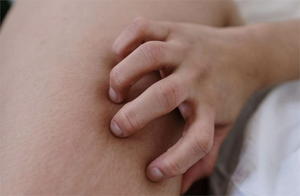 女壘國手球衣下「癢痛到流湯流水…」   精準治療揮別異位性皮膚炎