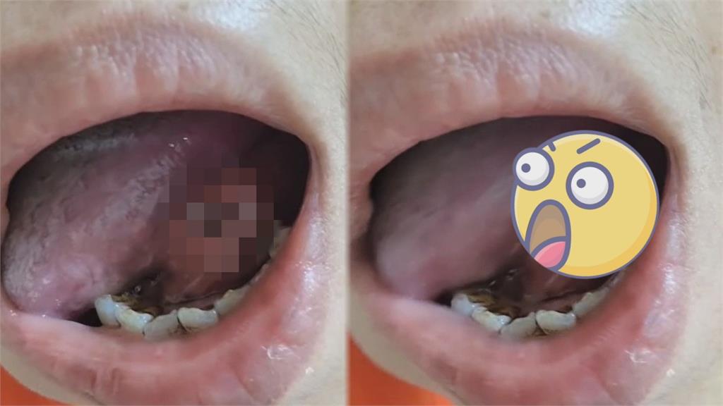 拔牙舌頭遭「鑽出大洞」！醫辯破皮而已　網一看驚呆崩喊：毛骨悚然