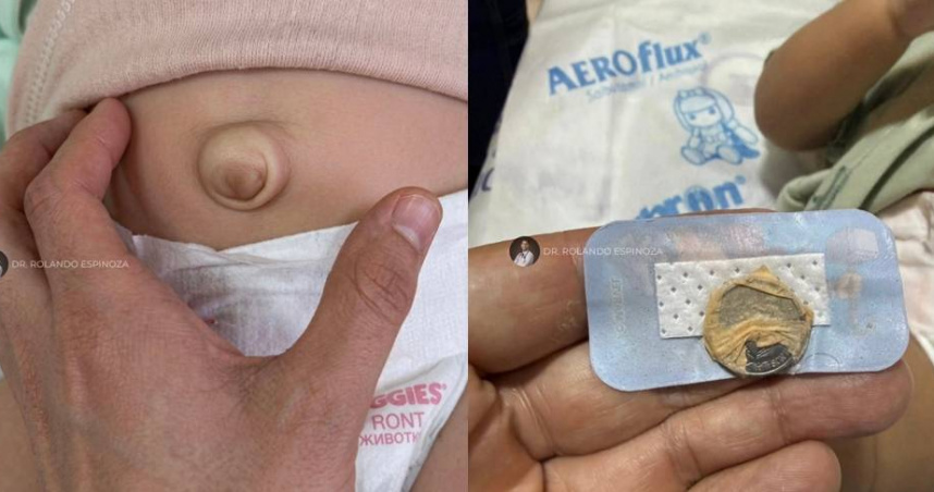 嬰肚臍凸出被長輩「貼硬幣24小時」壓平　小兒科醫曝最慘後果