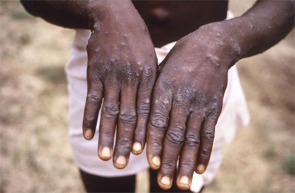 賴比瑞亞通報2018年來首例猴痘病例　疫情已蔓延逾75國