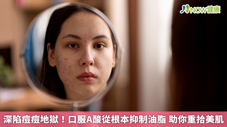深陷痘痘地獄!口服A酸從根本抑制油脂 助你重拾美肌