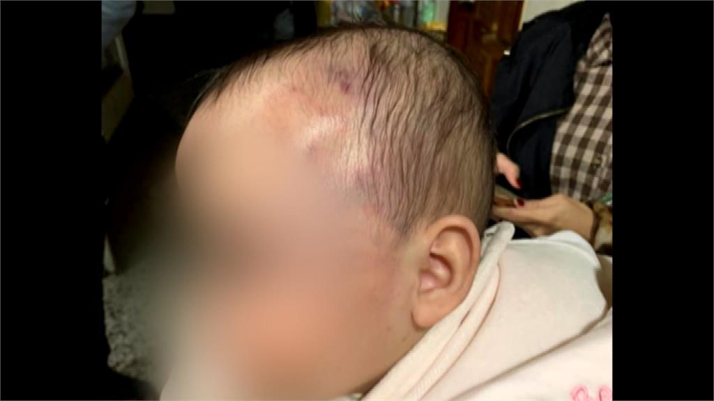 女嬰臉部瘀青紅腫 母親驗傷控訴保母