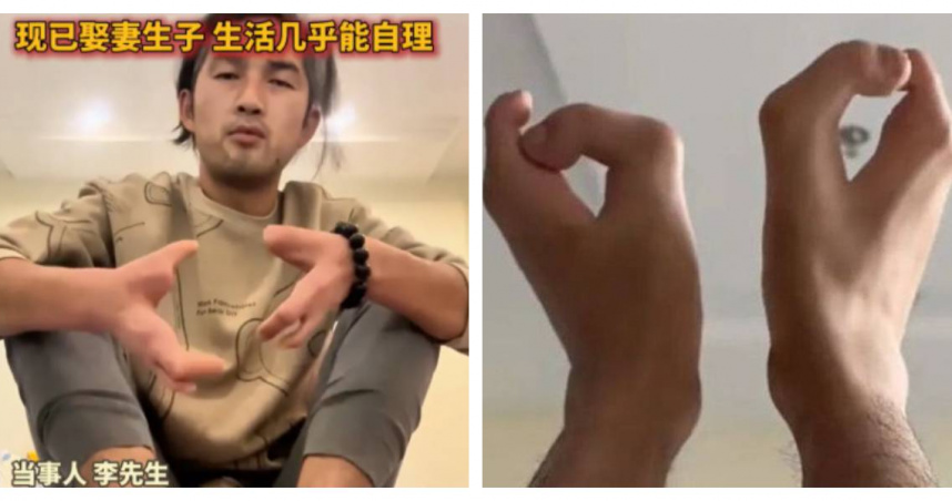 男子天生螃蟹手、牛蹄腳　真相竟是「祖輩是堂兄妹」隔代突變天生畸形