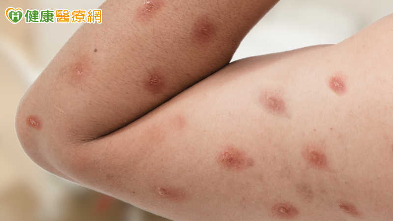 20多歲男染M痘！疾管署：台灣首見Ib型病毒株　小心5大皮膚症狀