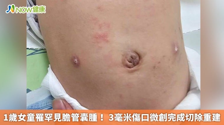 1歲女童罹罕見膽管囊腫！ 3毫米傷口微創完成切除重建
