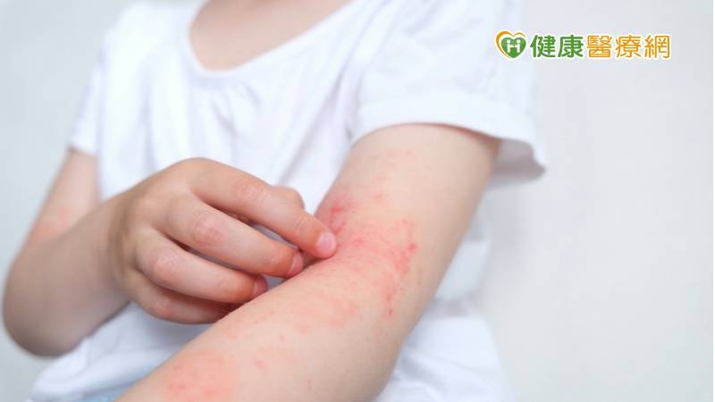 防異位性皮膚炎抓到皮流血　醫列「日常自救原則」