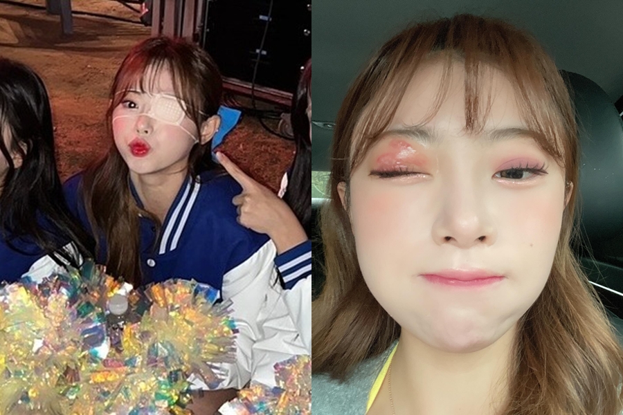 金娜妍每天僅睡2小時出事了！得皮蛇「眼睛在灼燒」　恐留永久疤痕