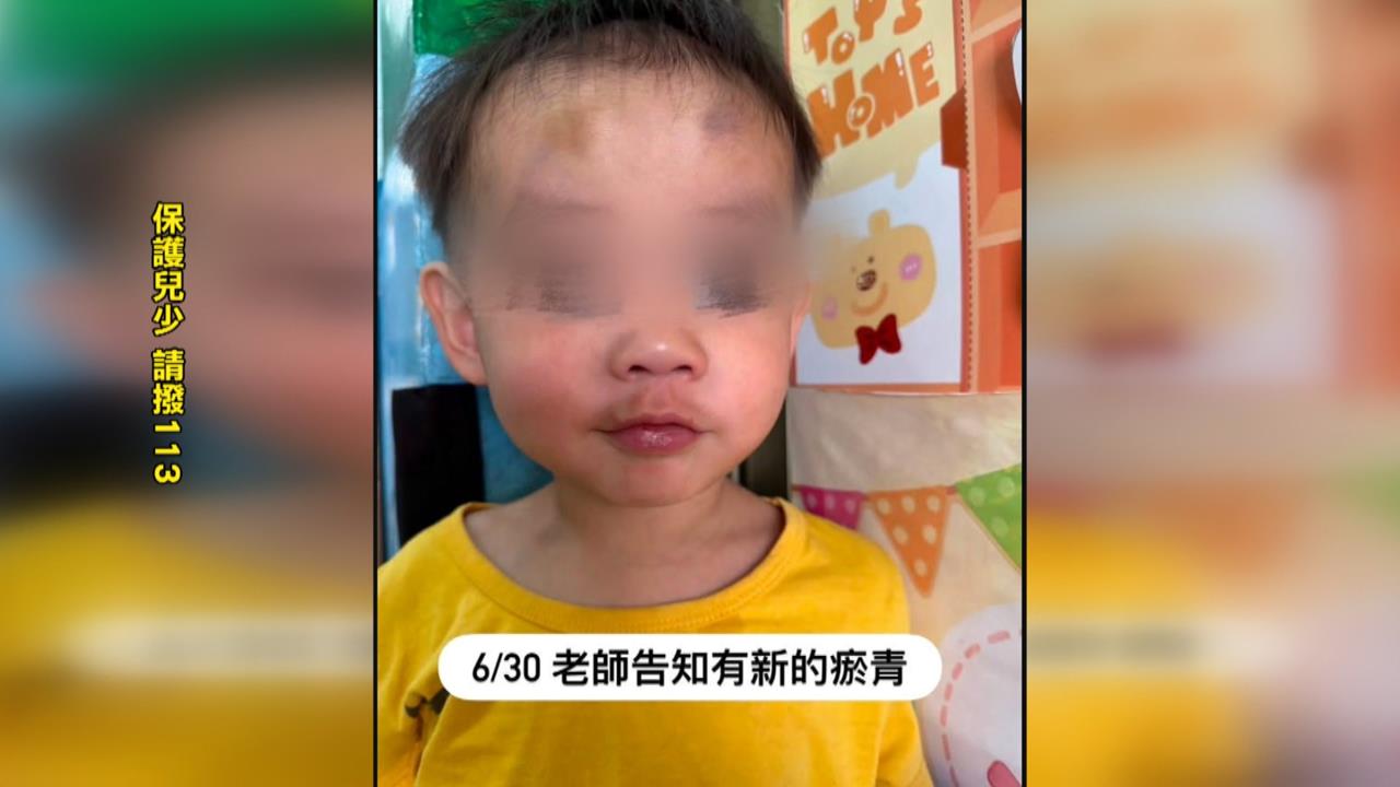 停托保母涉虐待！　孩子身上多處咬痕.瘀傷　母控保母虐待