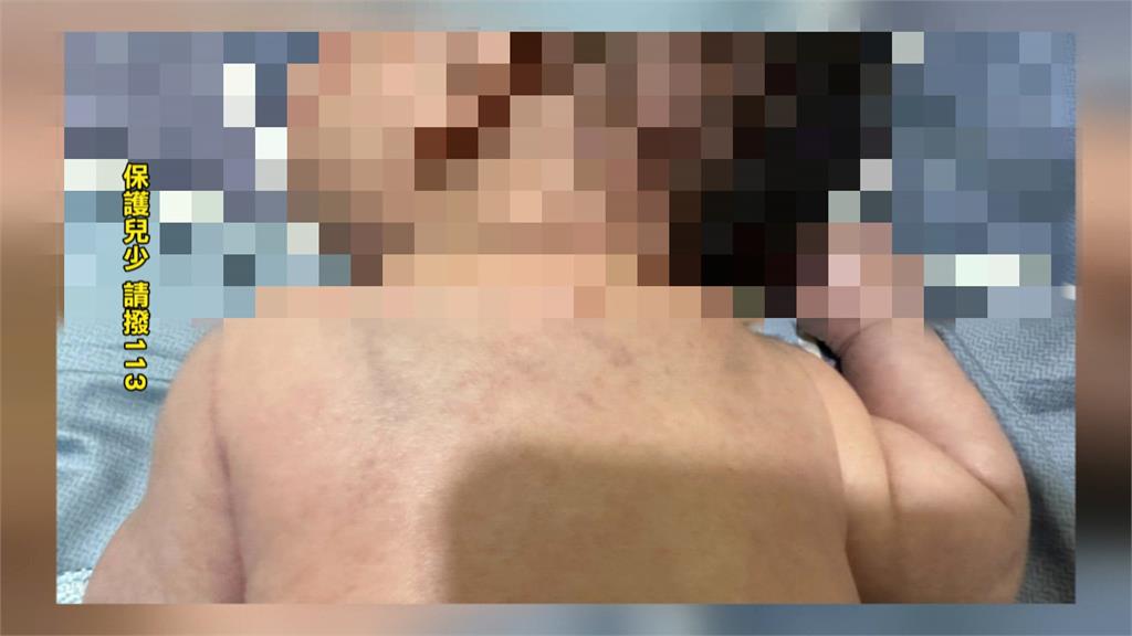 悚！家長信任保母護理師背景　男嬰疑卻遭不當對待滿身傷