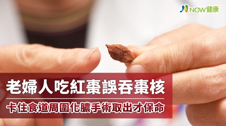 老婦吃紅棗誤吞棗核 卡住食道周圍化膿手術取出才保命