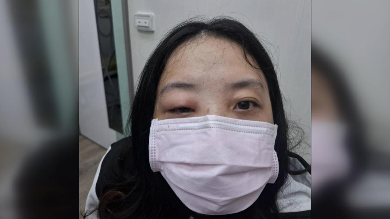 騎機車遭「蜜蜂攻擊」！　女子眼眶染蜂窩性組織炎