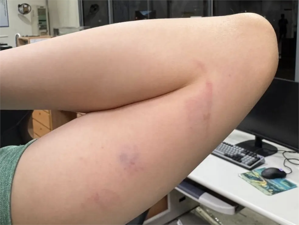 暴走病患持遙控器砸護理師　家屬冷回一句話引爆眾怒