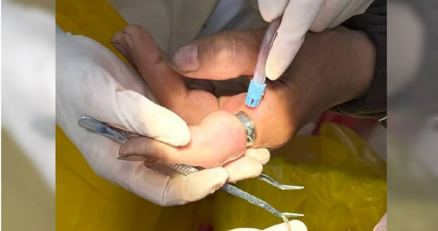 女子戒指太緊「手指腫脹發黑」險截肢 消防員沒轍!牙醫驚險解危