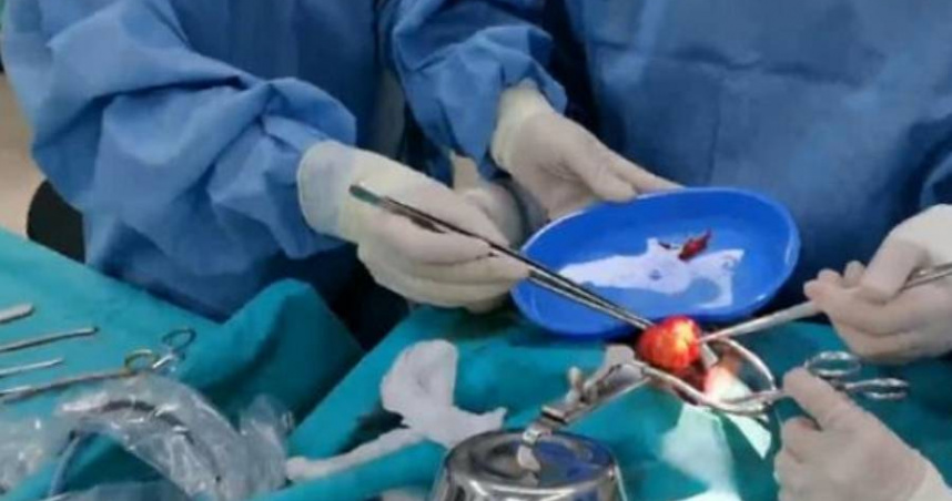 6歲男童狂打呼又挑食　咽喉卡「雞蛋大腫瘤」！醫驚呼：未發育雙胞胎