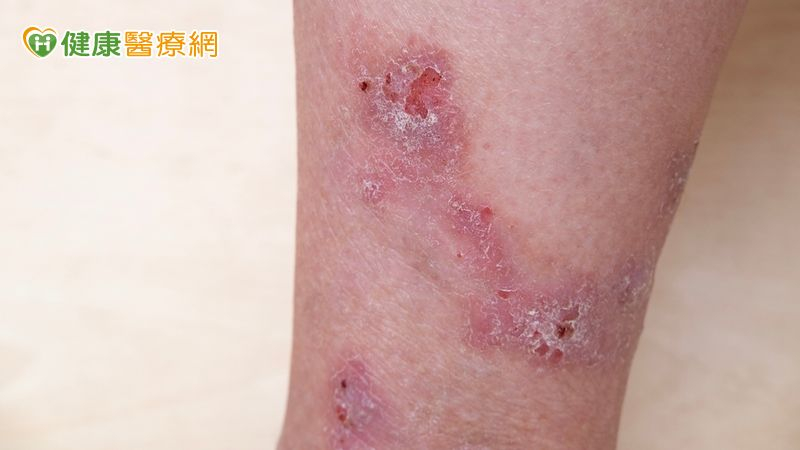 被蚊蟲咬想止癢別用偏方 醫師傳授夏季皮膚保養4原則
