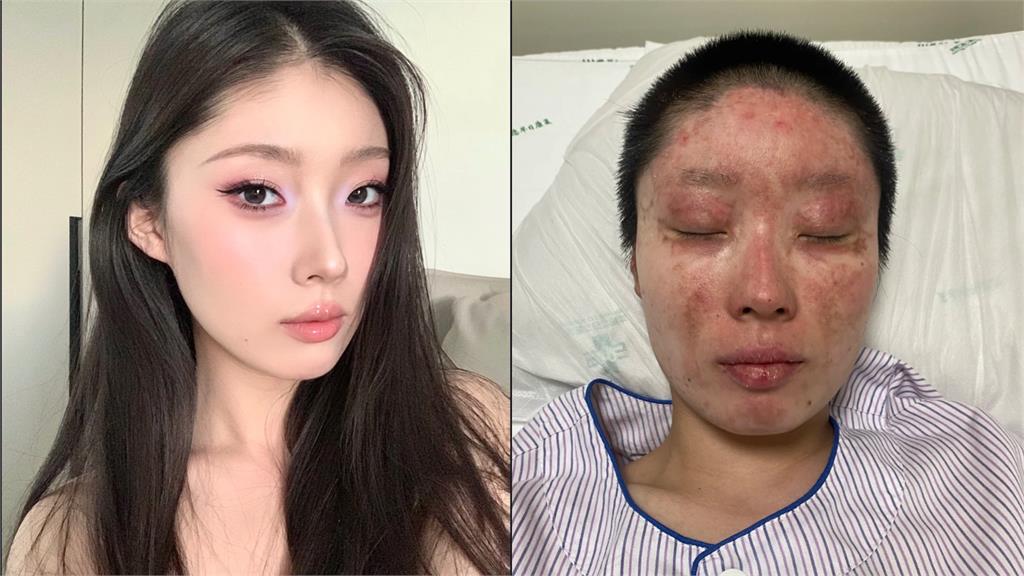 中國父點菸釀氣爆！美女網紅陷火海「慘毀容」…拍片賺醫藥費挨酸「博同情」