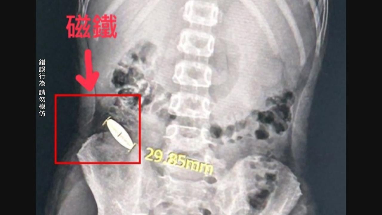 離譜！６歲童被小五生「逼吞3公分磁鐵」　補習班涉三項違規遭開罰