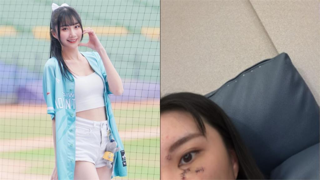 孫生前女友出事了！浴室玻璃門突爆裂「割傷濺血」急送醫　最新傷勢曝光