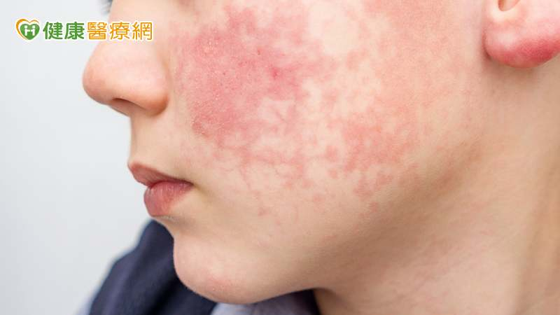 赴日前必知!「蘋果病」究竟是什麼?症狀、預防方式一次看
