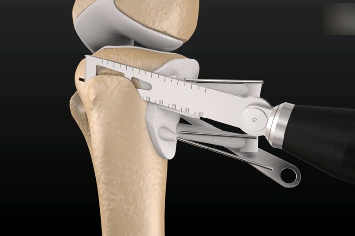 3D列印輔助骨科手術 重拾好膝力非難事