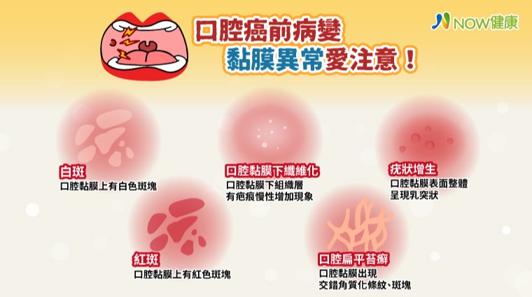 你是口腔癌高危險群嗎？ 口腔癌前病變黏膜異常愛注意