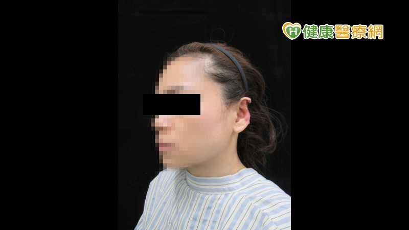 耳朵被人咬掉　整外醫師3次手術斷耳再造