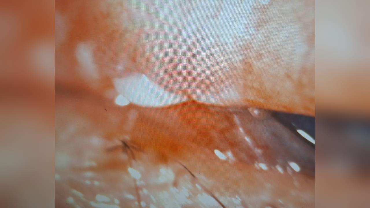 罕見！高雄女遭瑪爾濟斯狠咬　「狗牙卡眼」險失明